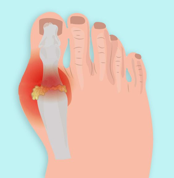 Gout: Symptoms, Causes, and Treatment